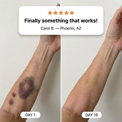 💥100K+ SOLD💕- ZURRUZ® Bruise Repair & Skin-Strengthening Cream